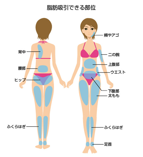 脂肪吸引できる部位