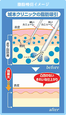 脂肪吸引用カニューレについて